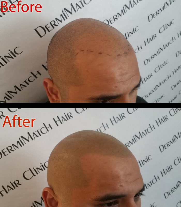 scalp micropigmentation in Scottsdale, AZ for thinning hair - scalp micropigmentation in Scottsdale, AZ for thinning hair