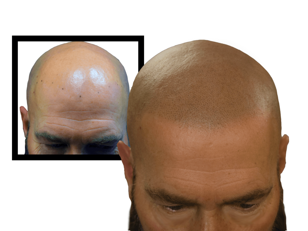 Top Hair Loss Solution DermiMatch Hair Clinic Scalp