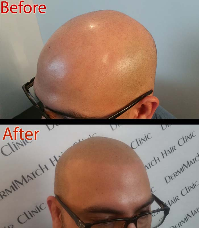 scalp micropigmentation in Scottsdale, AZ for thinning hair - scalp micropigmentation in Scottsdale, AZ for thinning hair