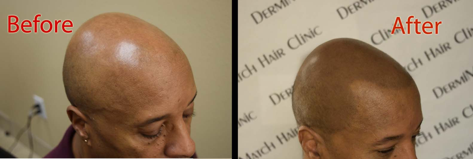 smp inBlonde scalp micropigmentation in Arizona for hair transplant grow hair az