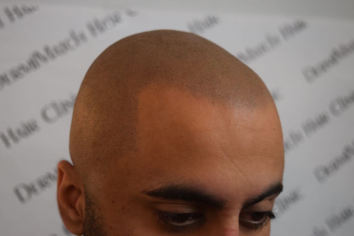 scalp micropigmentation arizona