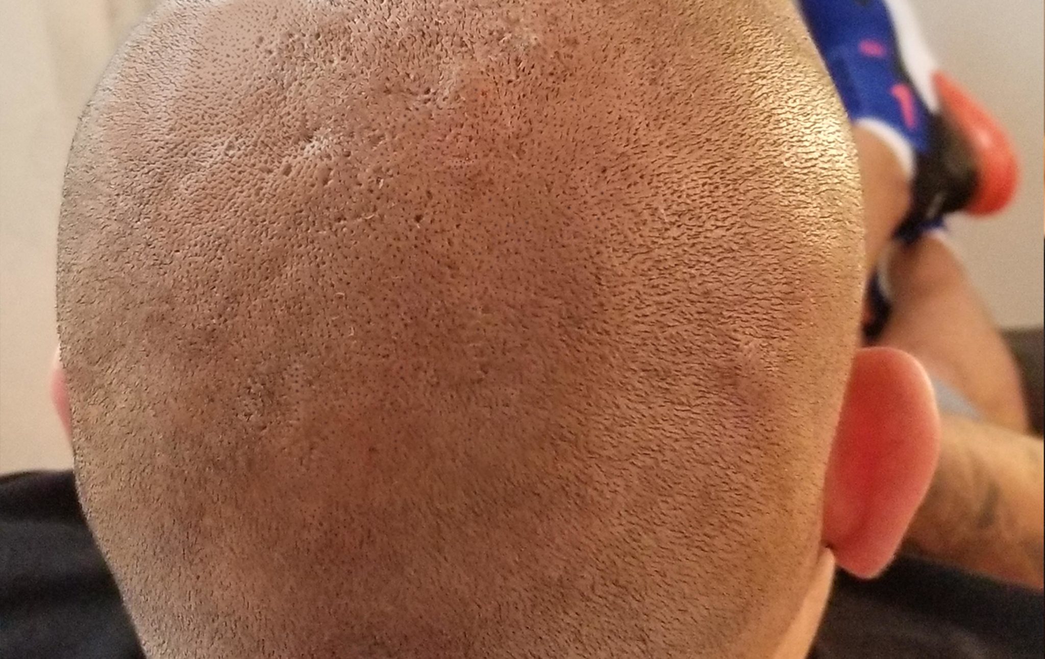 Before and After DermiMatch Hair Clinic Scalp Micropigmentation