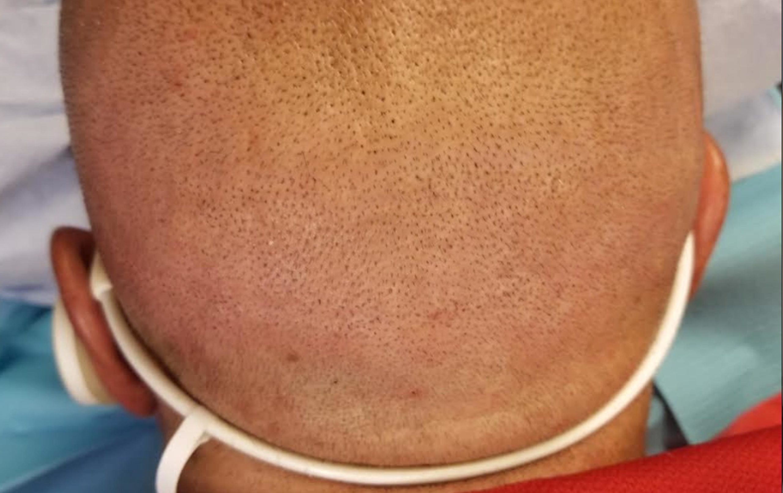 Hair Transplant Scar cover-up