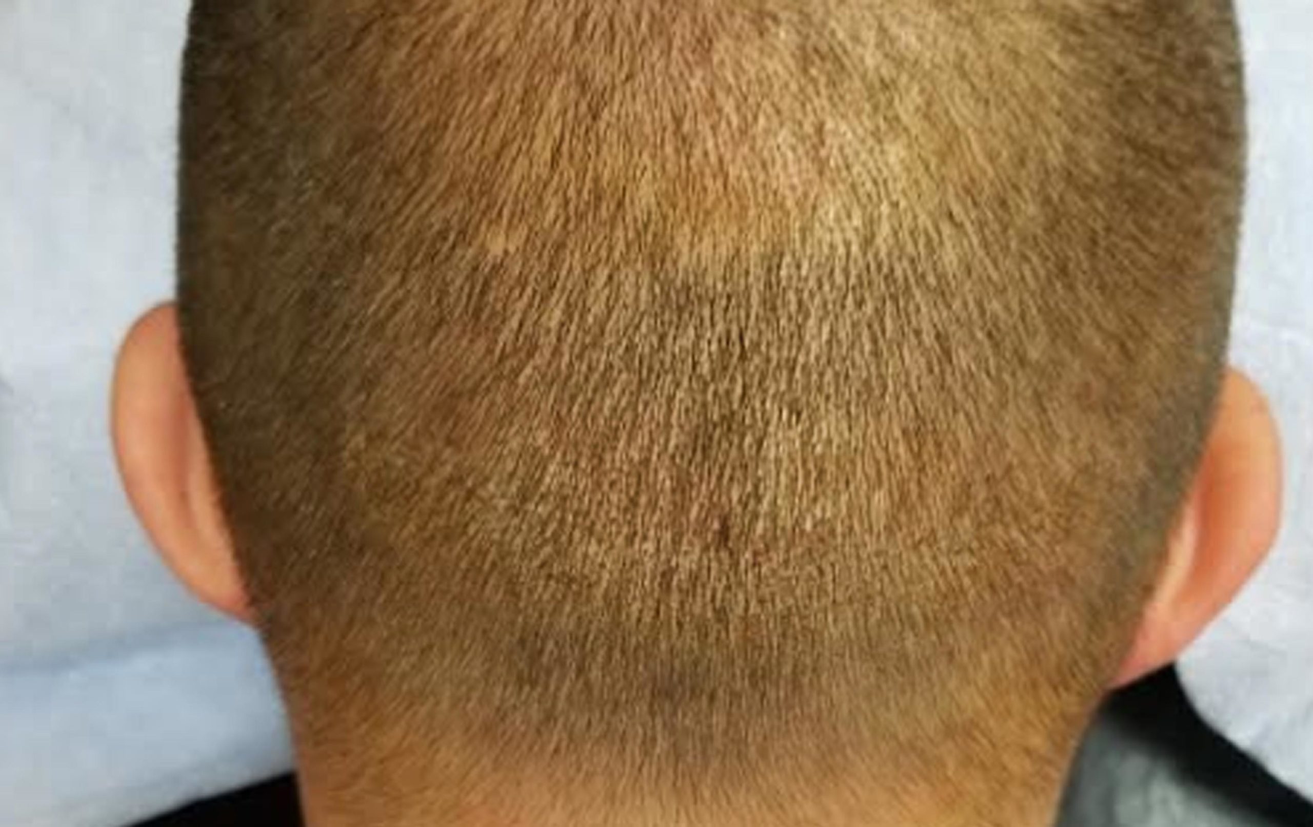 FUE camouflage scalp micropigmentation arizona