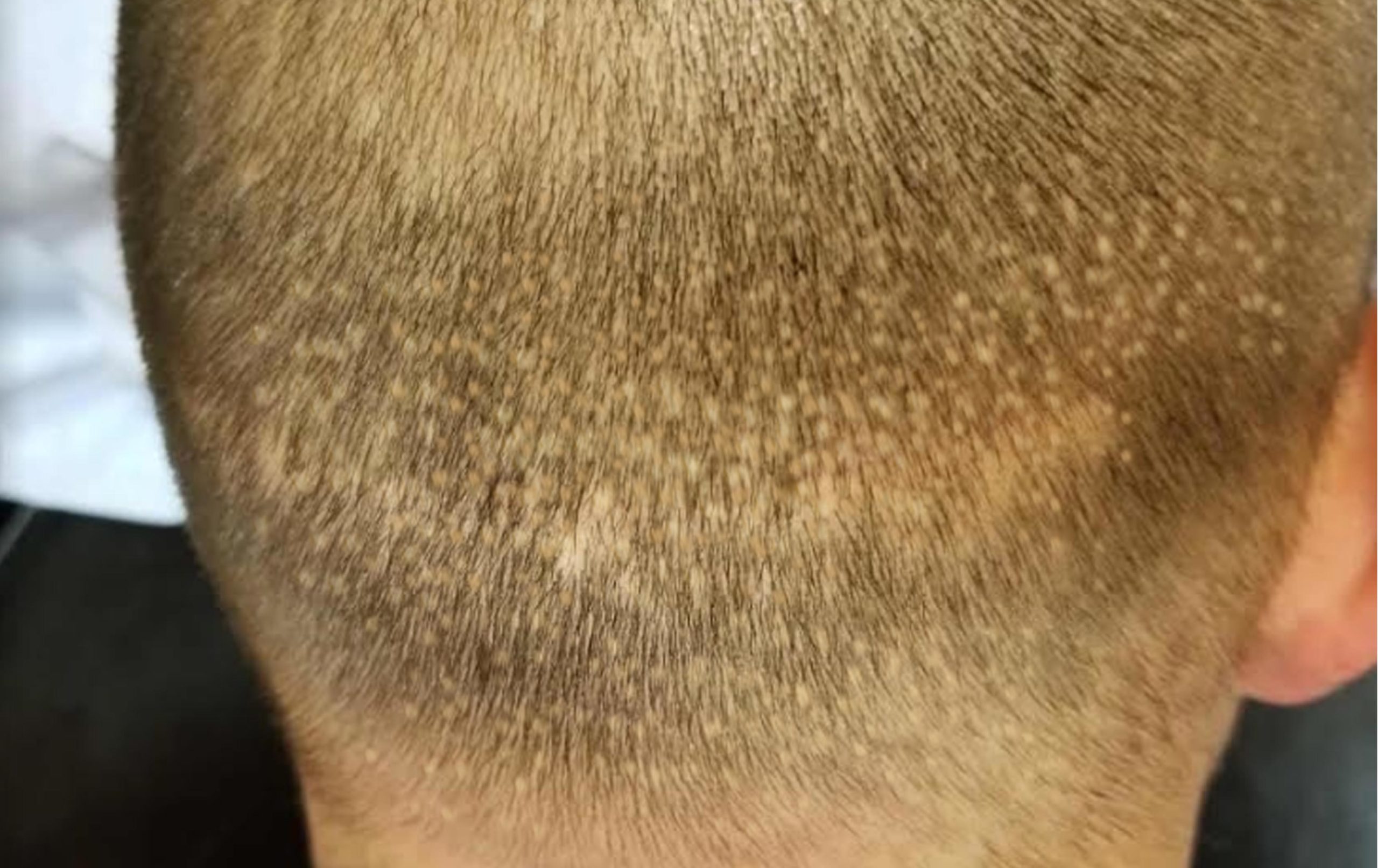 FUE camouflage scalp micropigmentation arizona