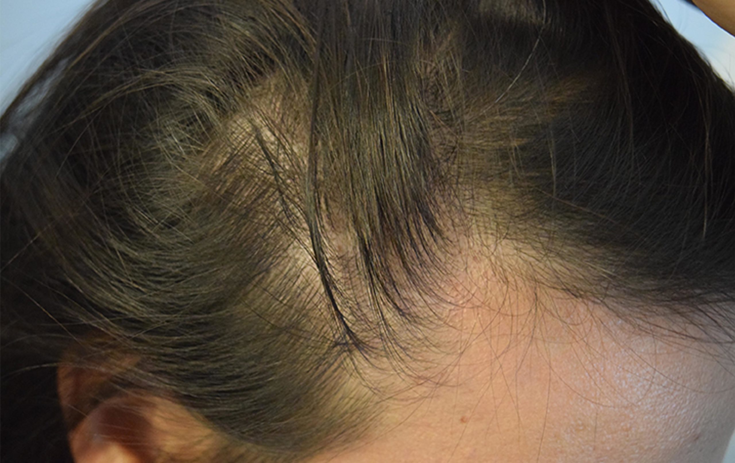 SMP on thinning hair woman sides