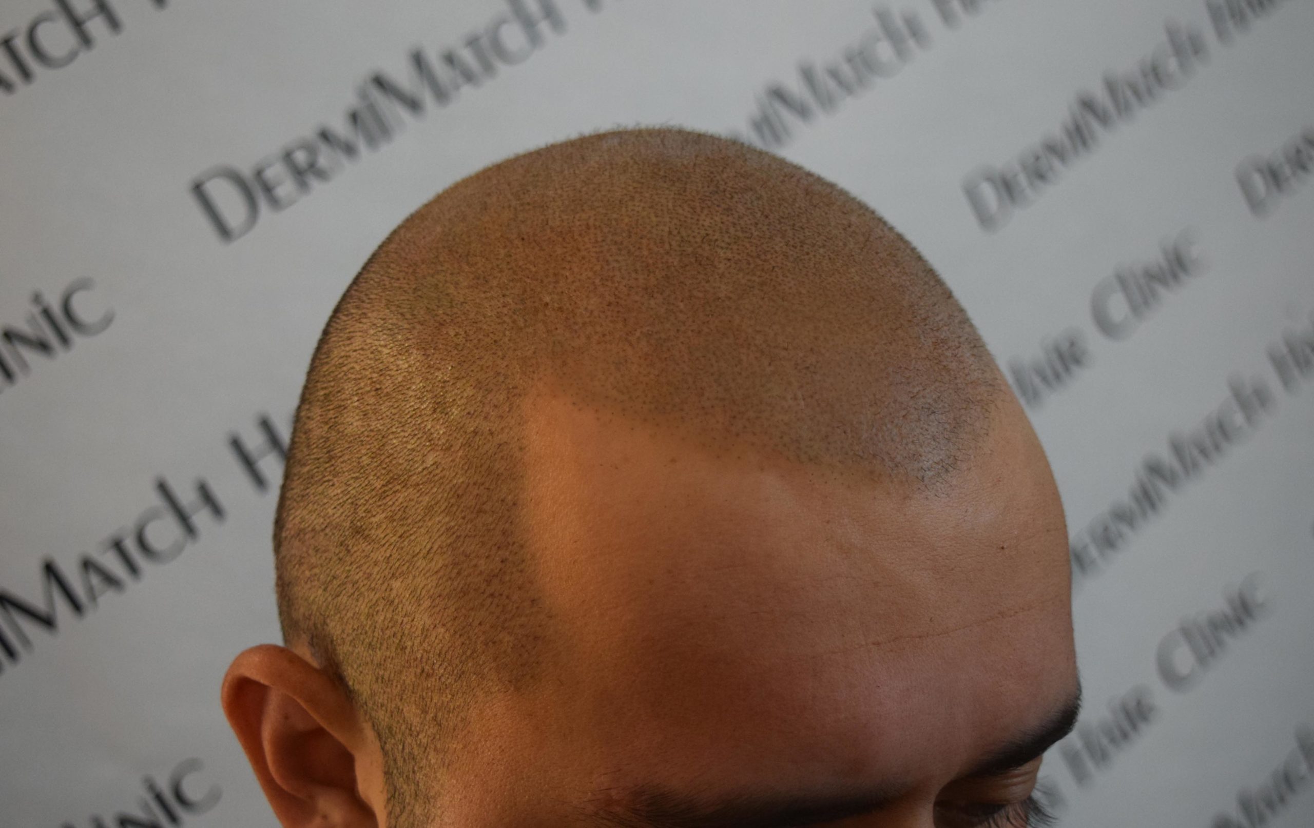 smp on hair transplant ht FUE