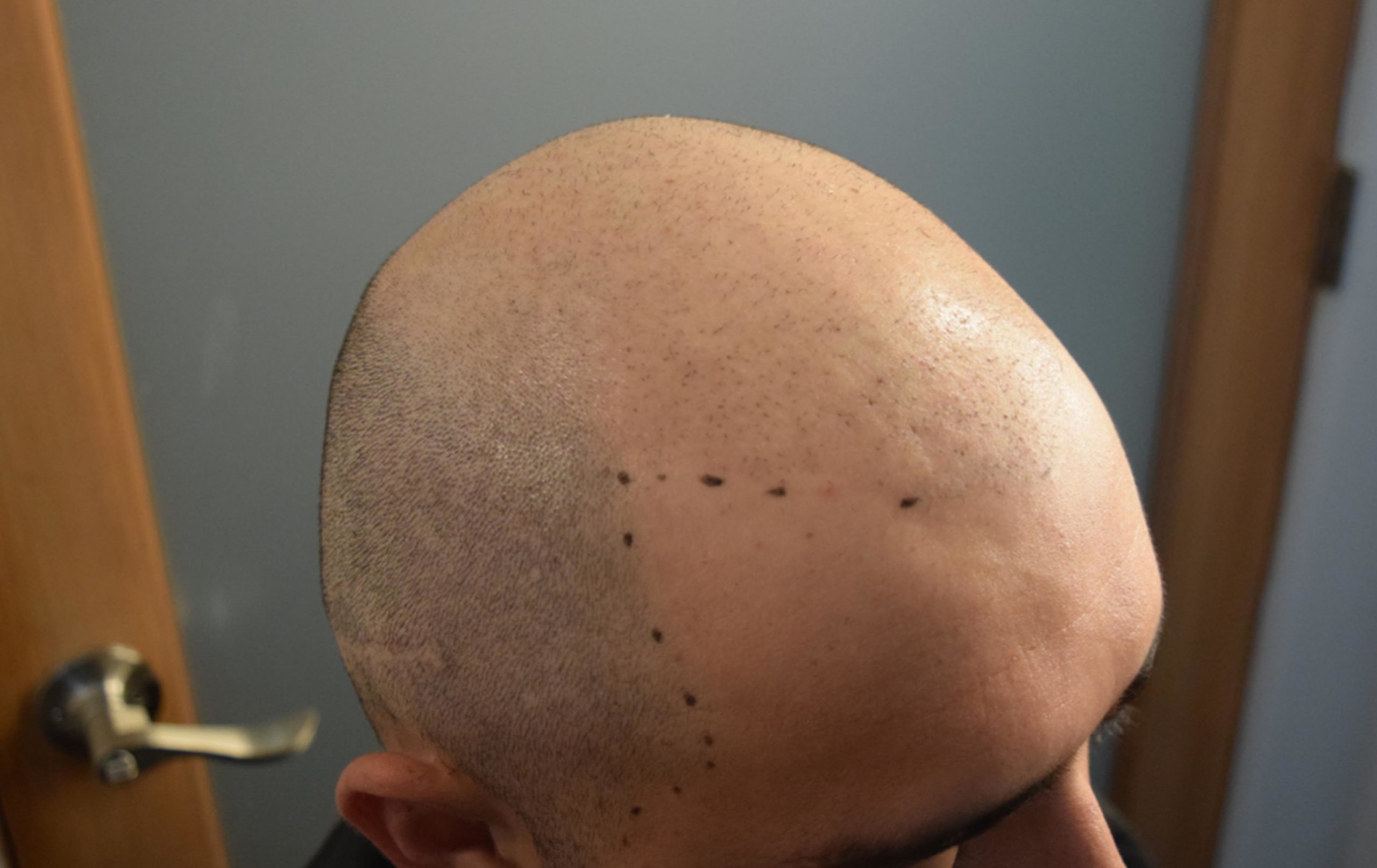 scalp micropogmentation on hair transplant