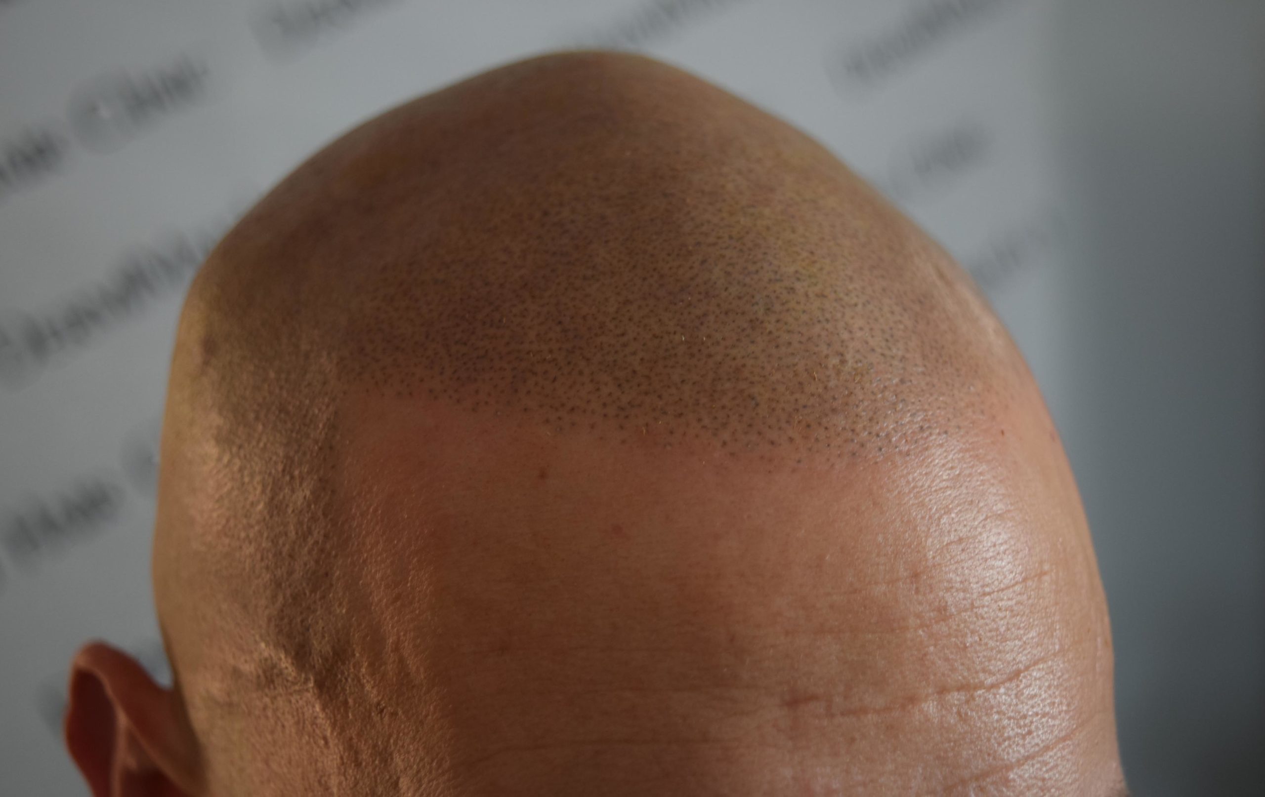 hair transplant density with scalp micropigmentation