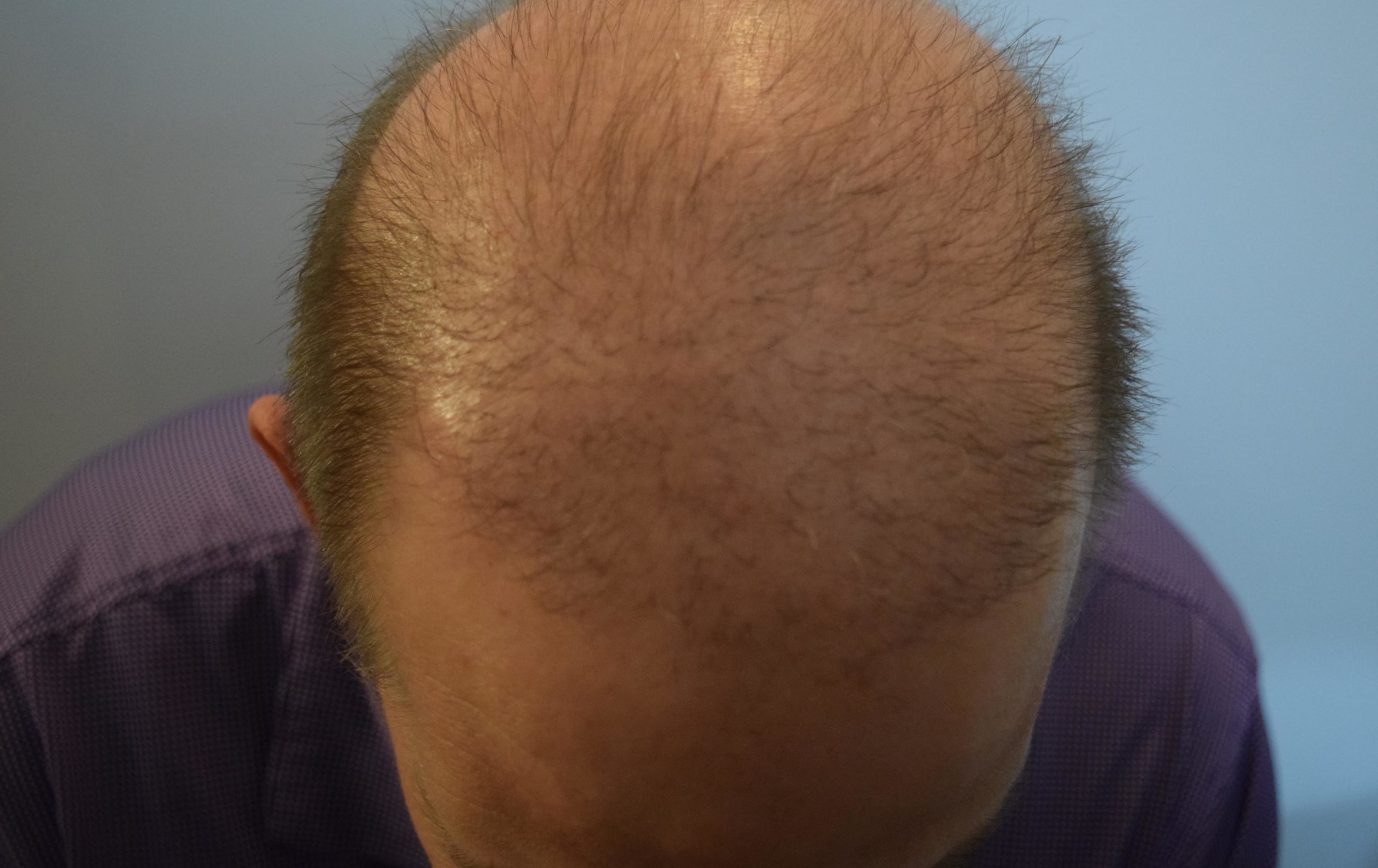 hair transplant density