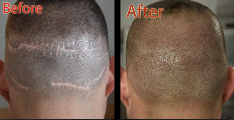 scalp micropigmentation SMP versus tattoo