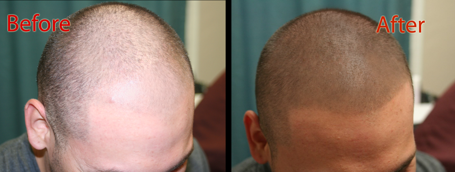 scalp micropigmentation smp in arizona