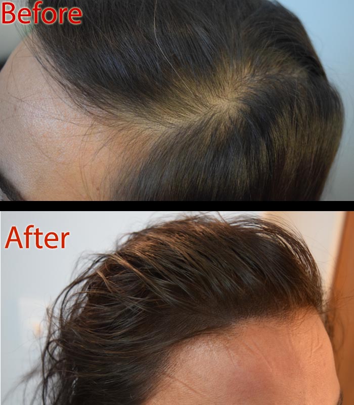 scalp micropigmentation smp for female hair loss