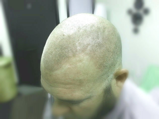 scalp micropigmentation smp in Arizona