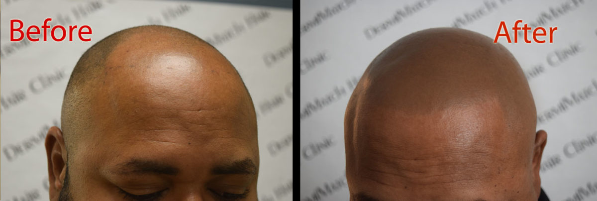 Is SMP in Arizona the Solution for Pattern Baldness