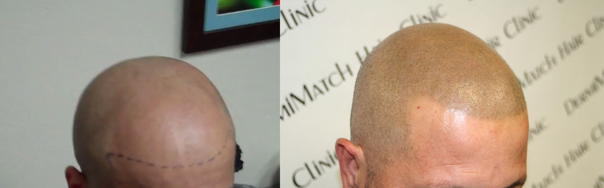 scalp micropigmentation smp