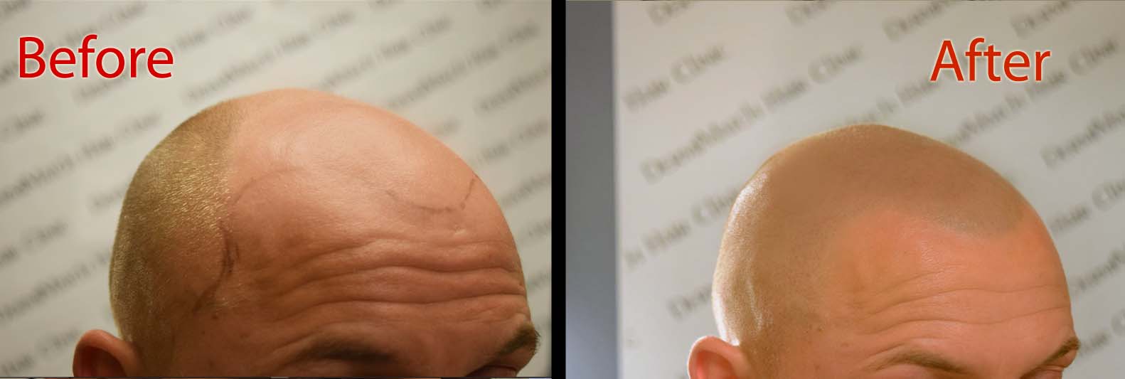 scalp micropigmentation SMP