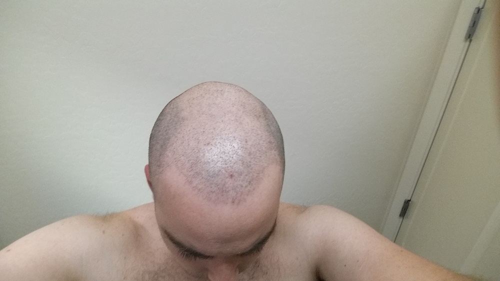 scalp micropigmentation smp for follically challenged problem