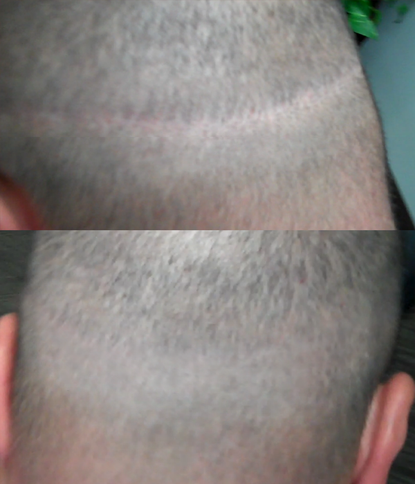 scalp micropigmentation smp in Phoenix