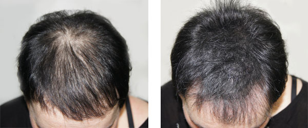 scalp micropigmentation smp in Phoenix