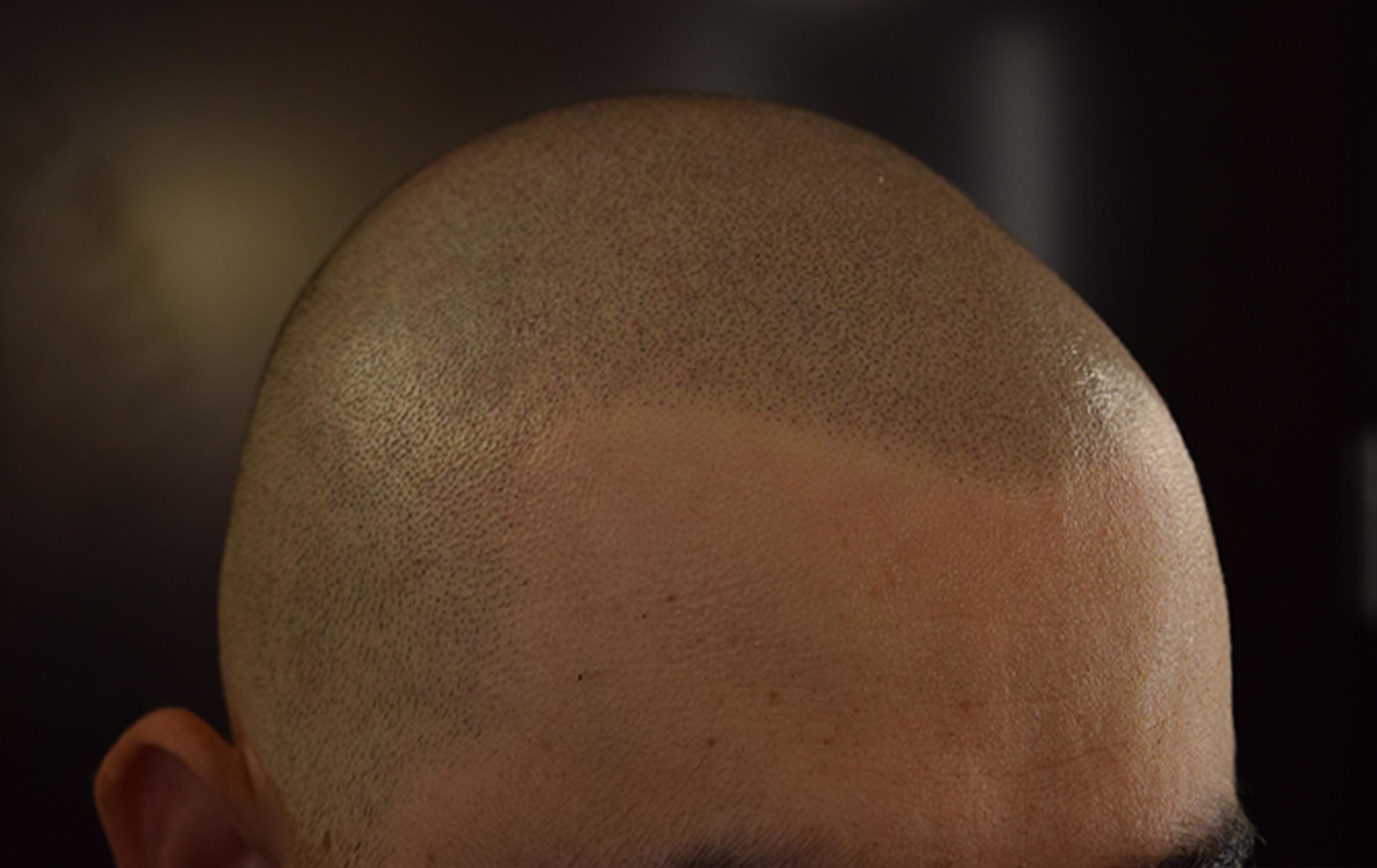 scalp micropigmentation smp in Phoenix