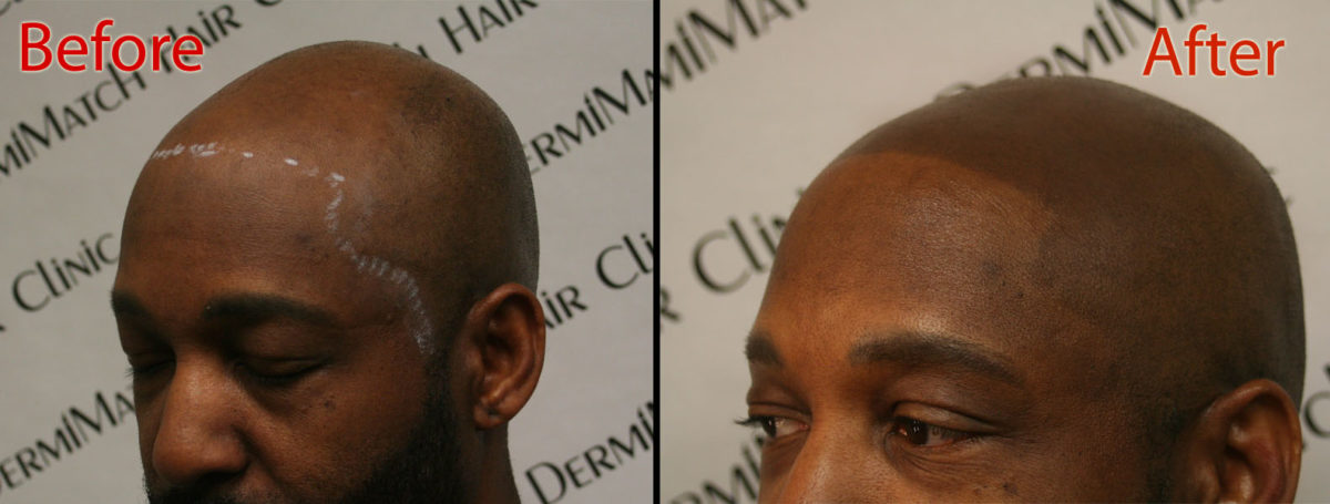 scalp micropigmentation smp