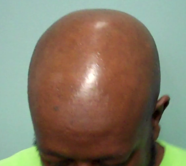 scalp micropigmentation SMP in Arizona