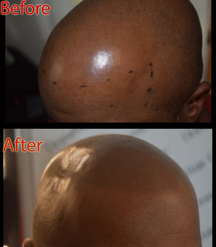 Tooth Infection-Hair Loss Connection