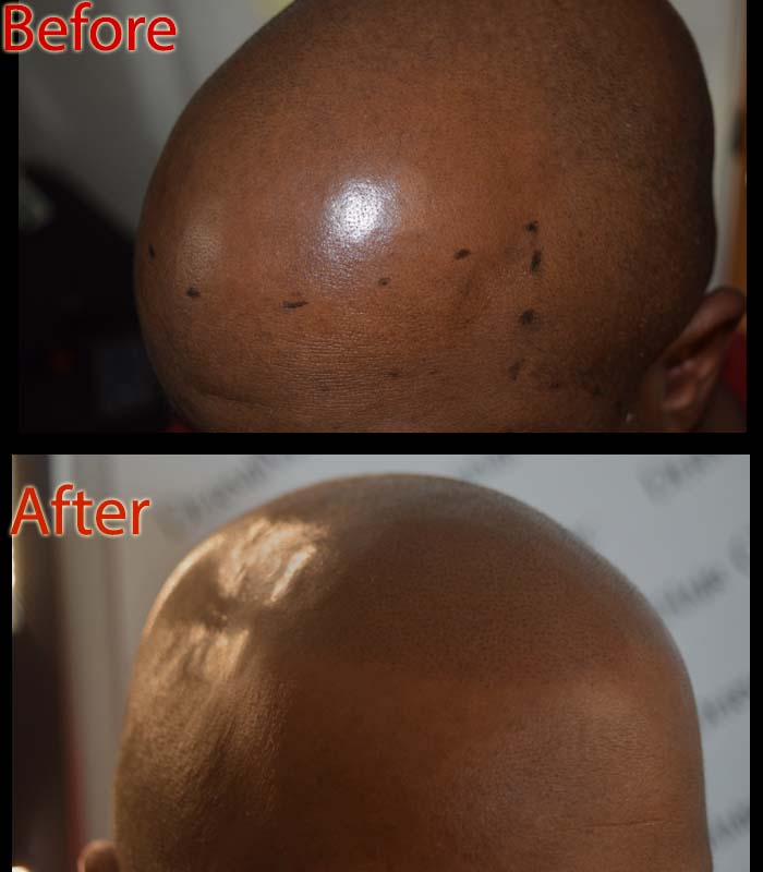 scalp micropigmentation smp