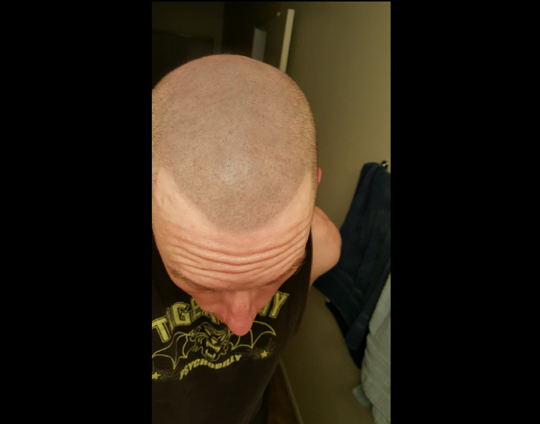 scalp micropigmentation smp