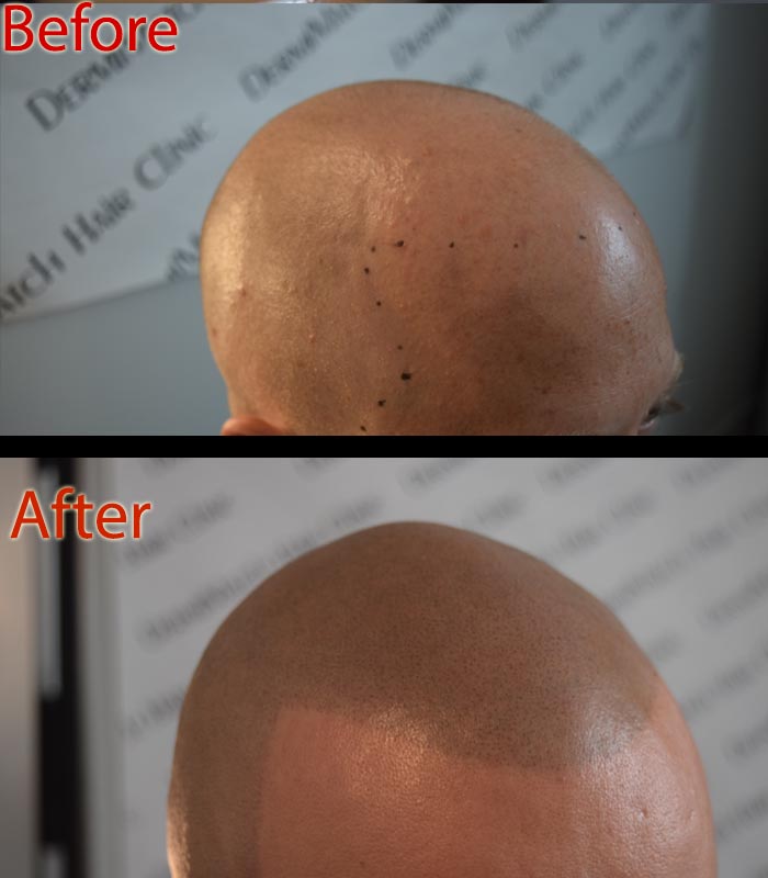 scalp micropigmentation SMP