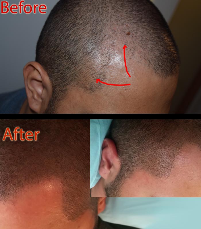 scalp micropigmentation SMP in Scottsdale to prevent hair loss