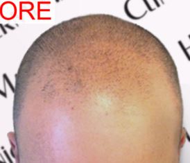 scalp micropigmentation SMP in Arizona