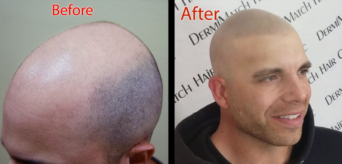 scalp micropigmentation SMP in Phoenix