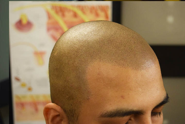 scalp micropigmentation smp hairlines