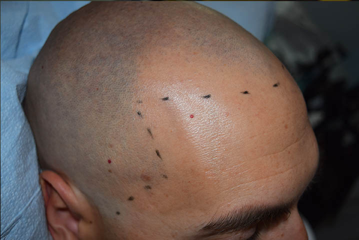 scalp micropigmentation SMP in Phoenix