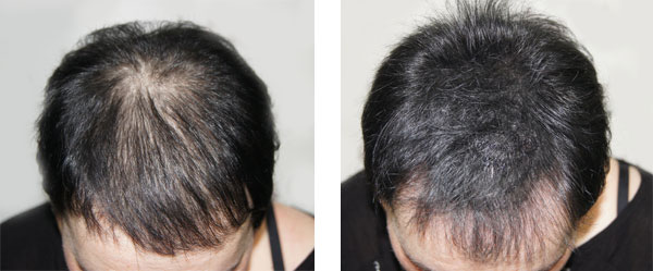 scalp micropigmentation SMP for steroid caused hair loss