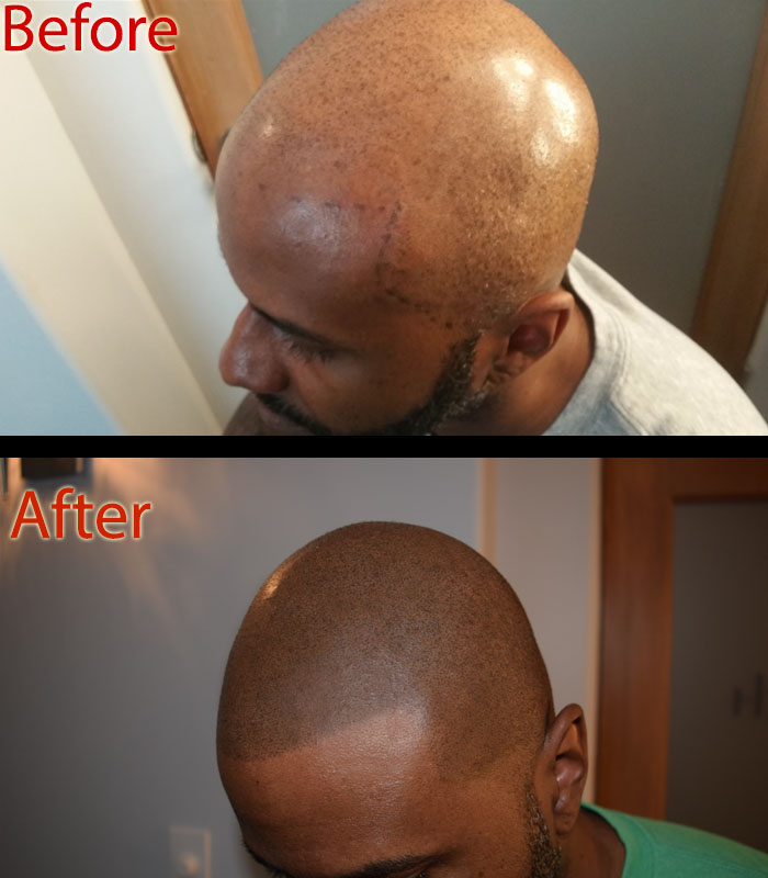 scalp micropigmentation SMP versus hair transplant