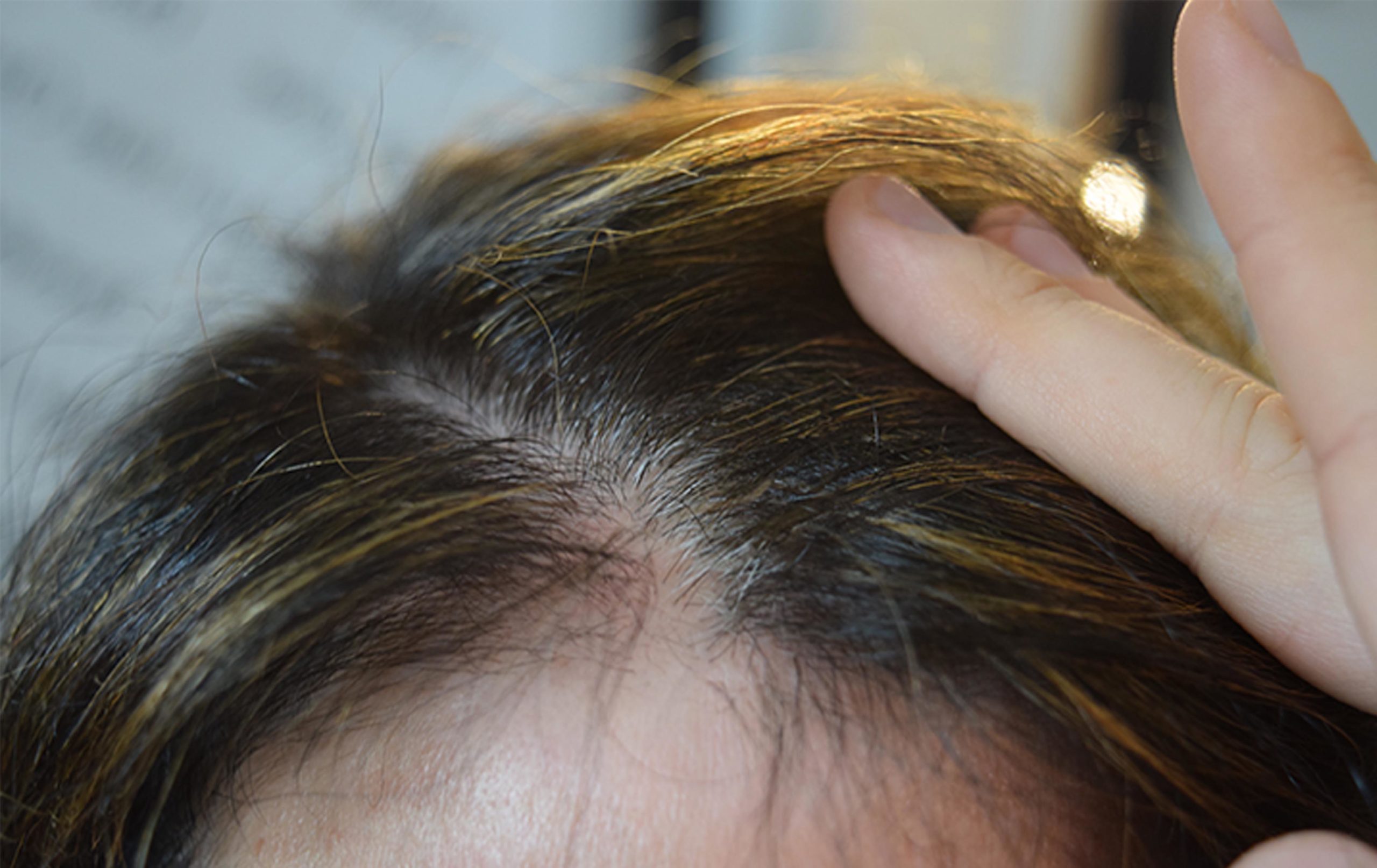 scalp micropigmentation SMP for postpartum hair loss