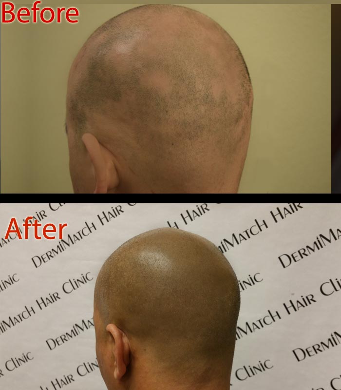 scalp micropigmentation SMP for dry scalp