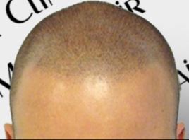 wear a hat after scalp micropigmentation SMP