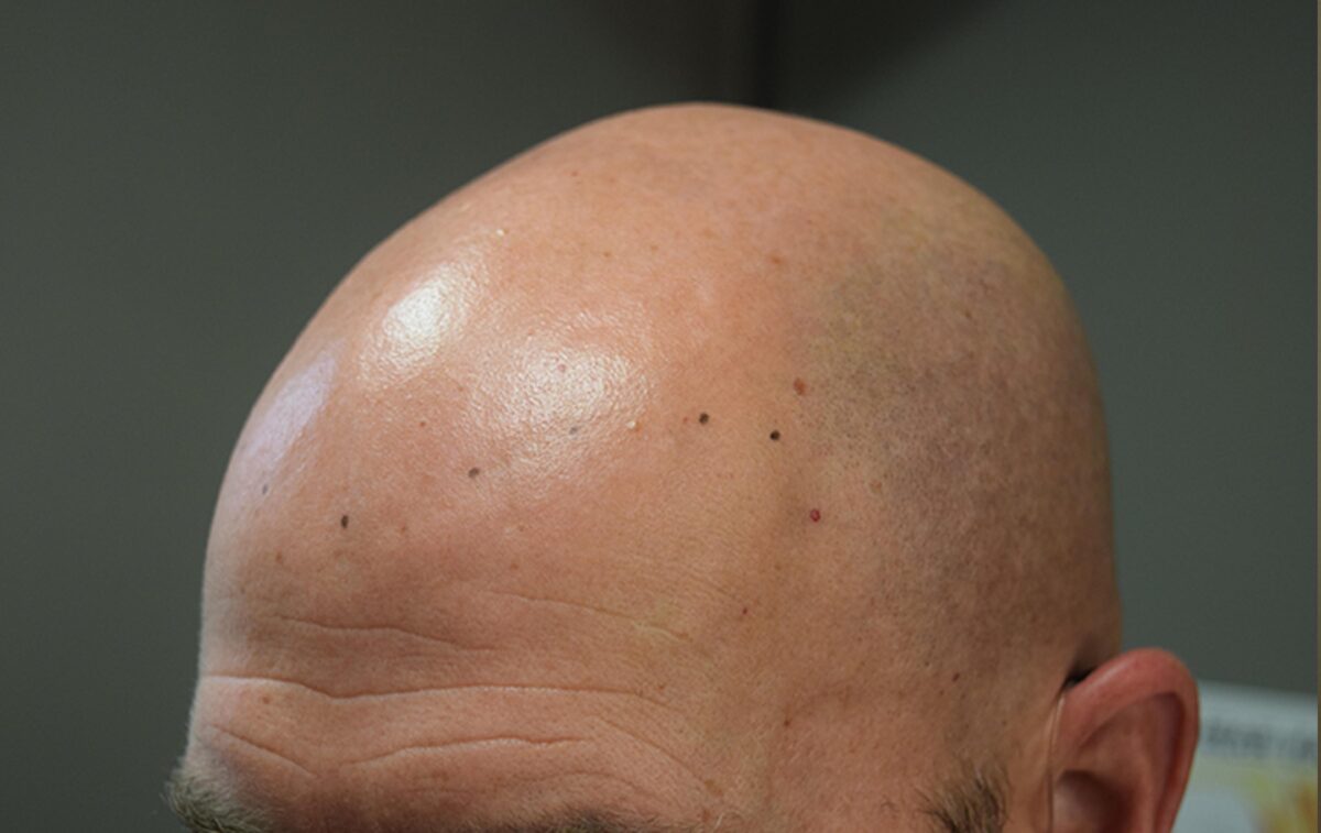 scalp micropigmentation SMP hair loss