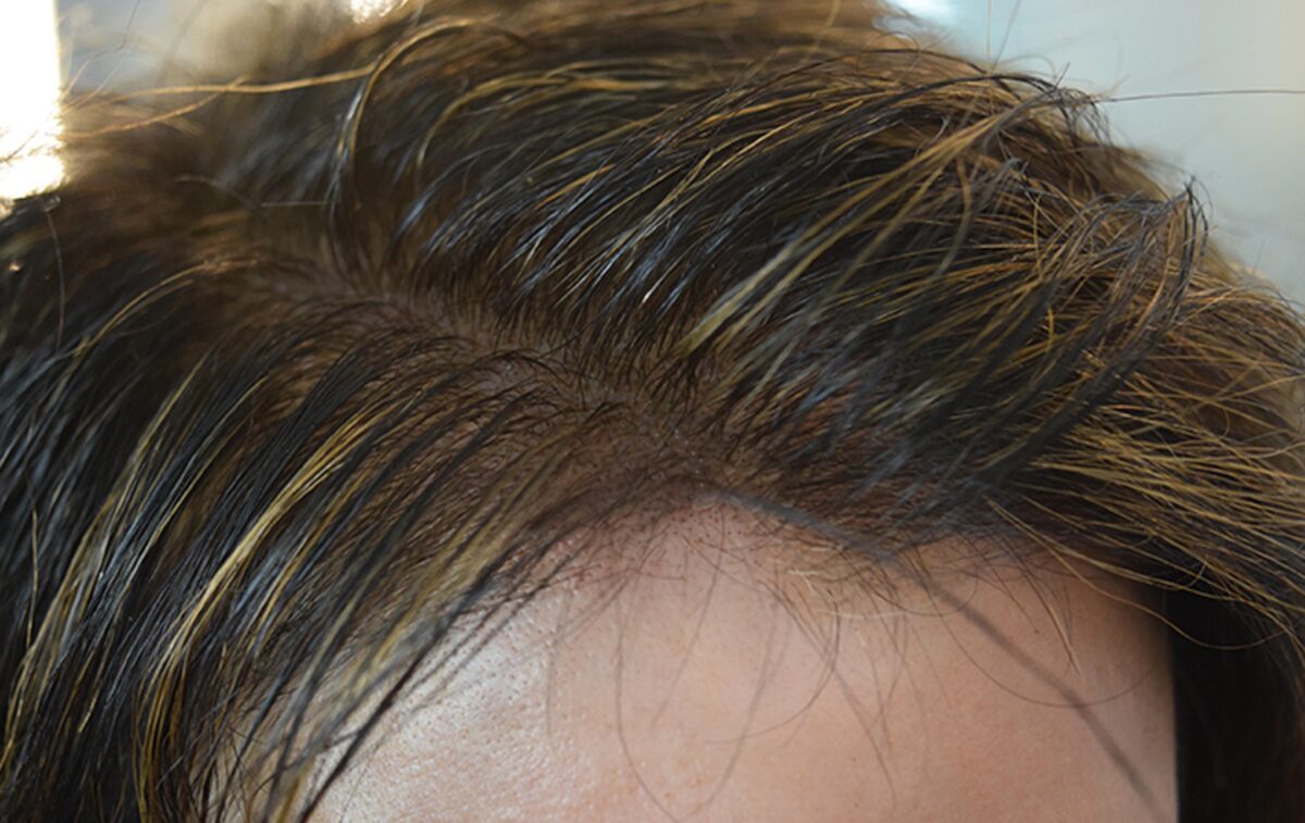 scalp micropigmentation smp for woman hair loss