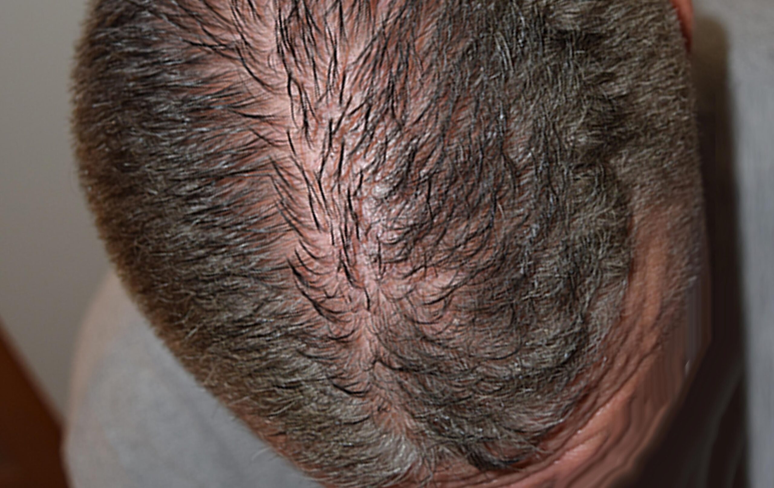 scalp micropigmentation SMP for hair loss