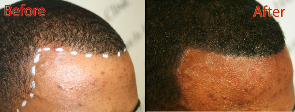 scalp micropigmentation smp for thick hair