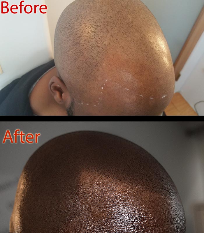 scalp micropigmentation SMP for nicotine-hair loss