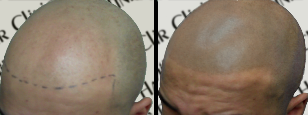 scalp micropigmentation SMP for dry scalp