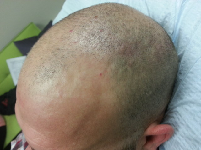 scalp micropigmentation SMP for male hair loss