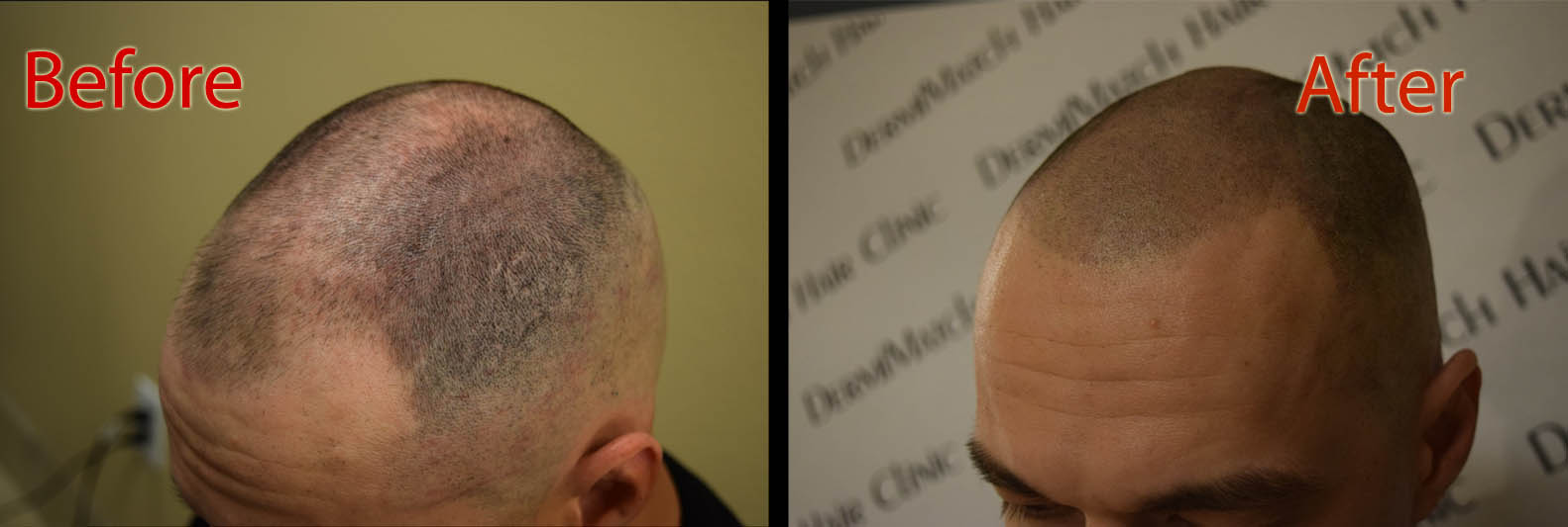 scalp micropigmentation smp for rheumatoid arthritis hair loss