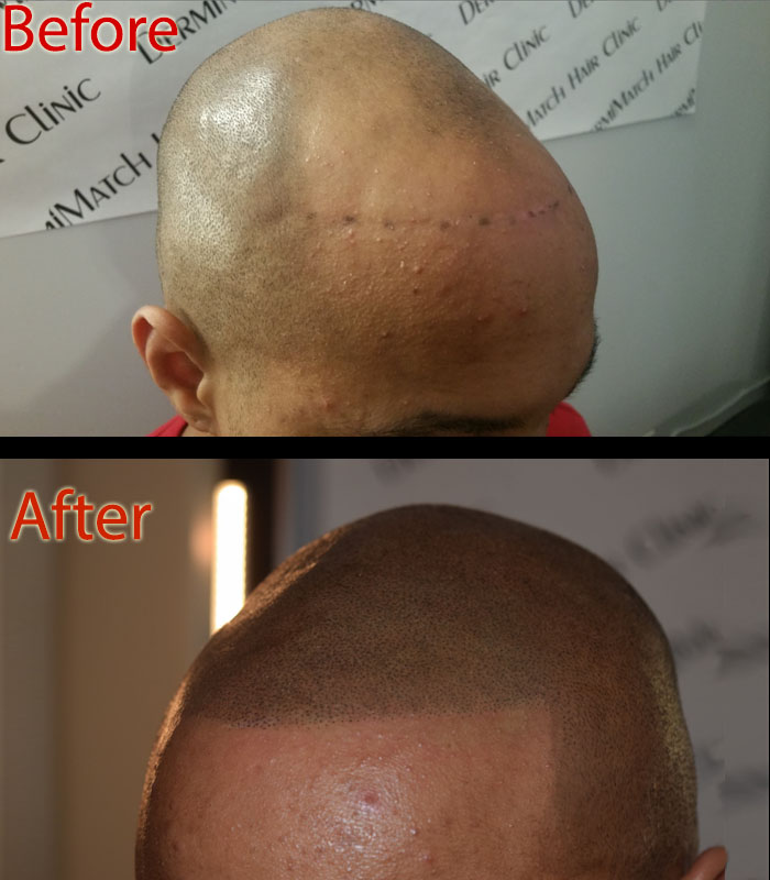 scalp micropigmentation SMP for pattern hair loss